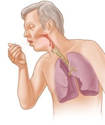 Obat Alami Penyakit Bronkitis Kronis